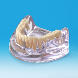 Implantat/Bro Studiemodel 